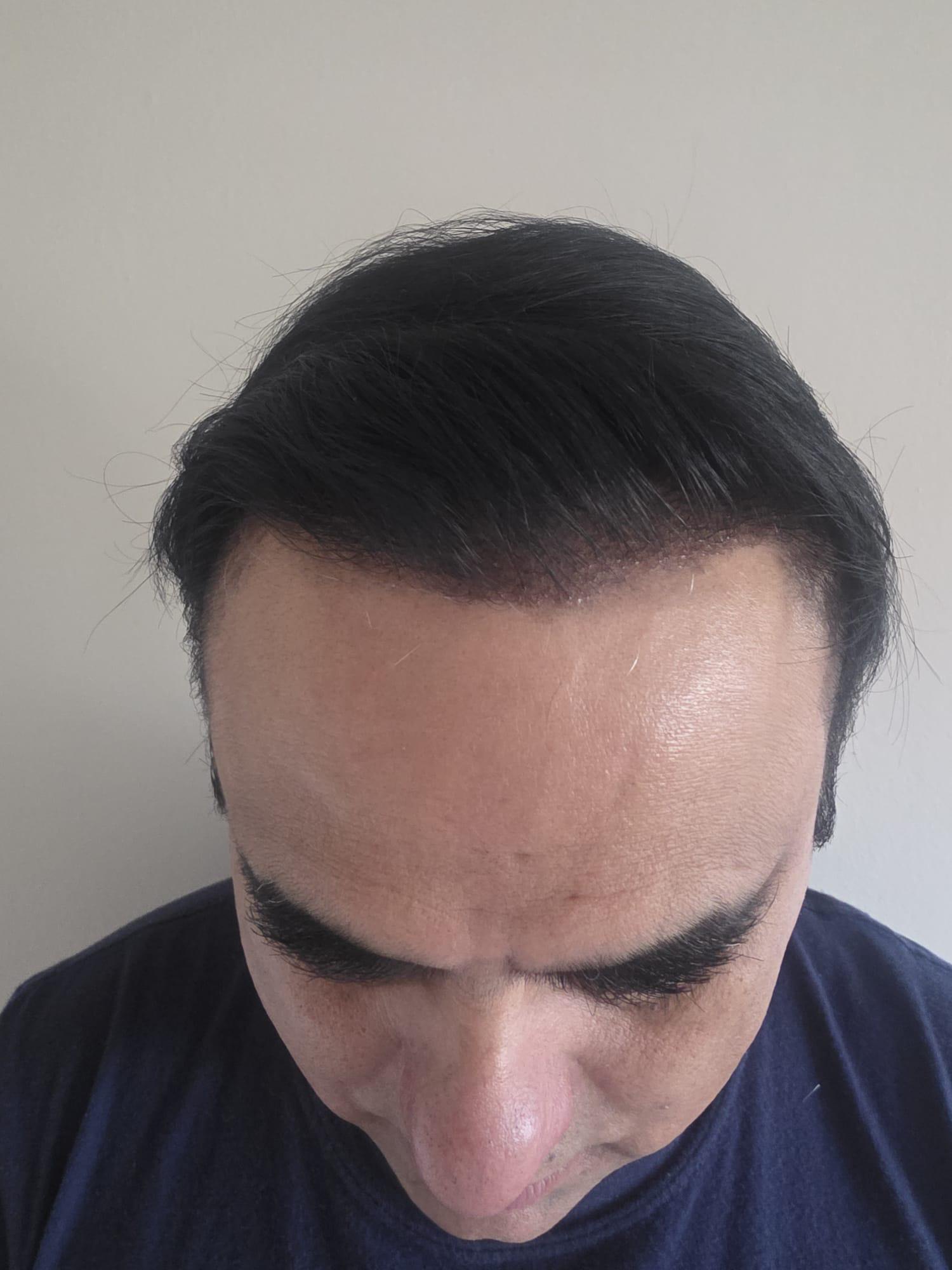 Nishant hair transplant result photo 8